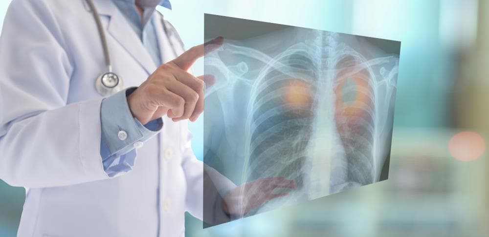 La silicosis y su impacto en el sector de la marmolería: Un análisis detallado 