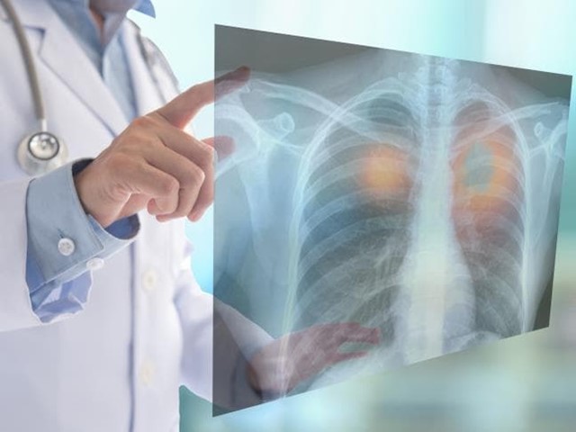 La silicosis y su impacto en el sector de la marmolería: Un análisis detallado 